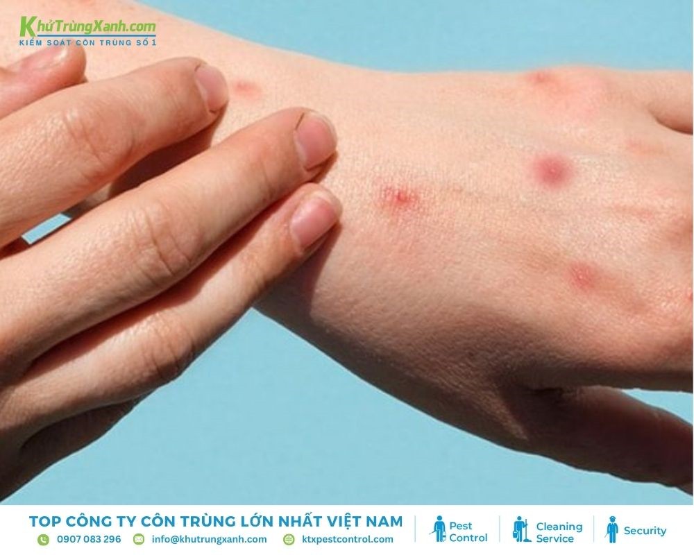 Những cách nhận biết bạn bị bọ chét cắn