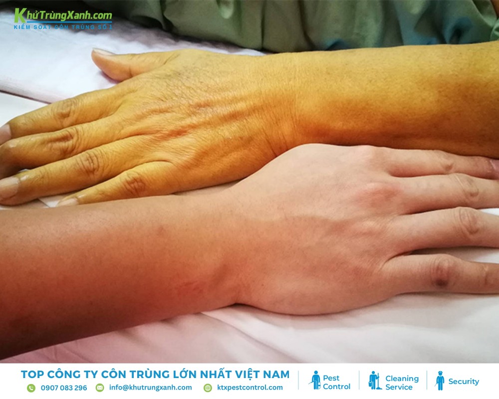 Muỗi là tác nhân gây nên nhiều chứng bệnh nguy hiểm ở người